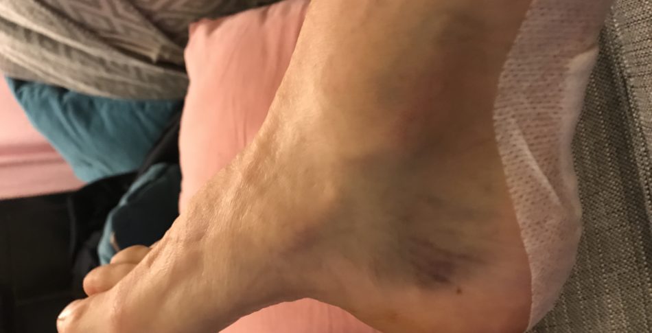 2 veckor efter operation.